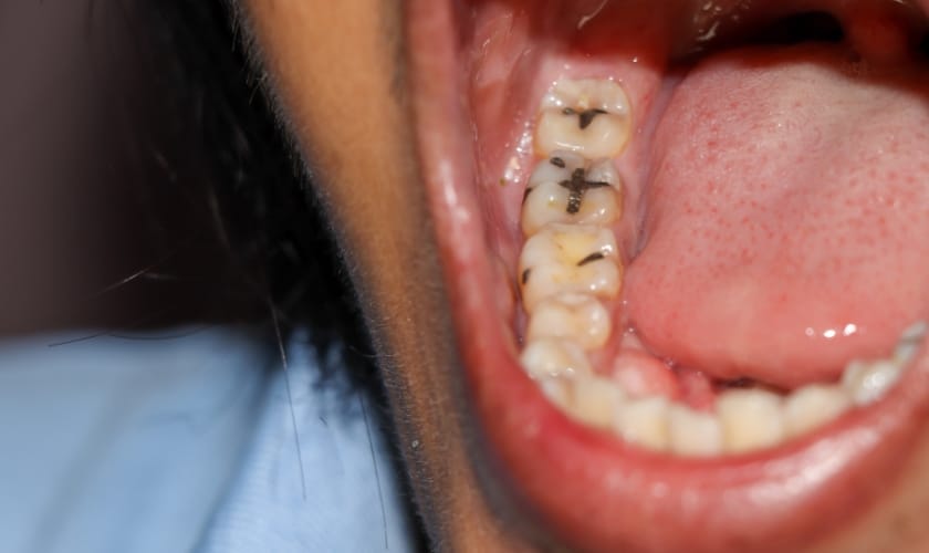 Black Spots on Teeth
