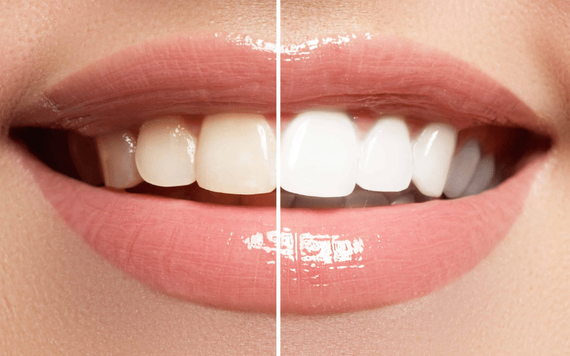Teeth Whitening Treatment