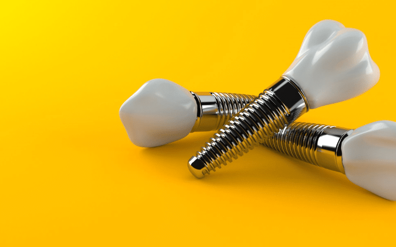 How To Take Care Of Your Dental Implants