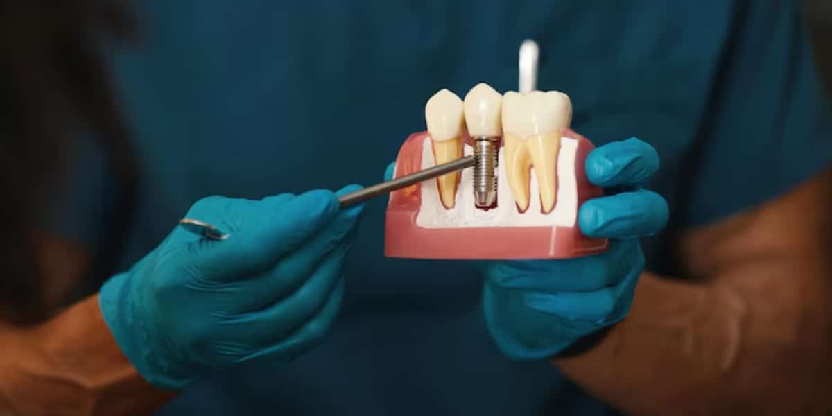 how long do dental implants last